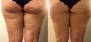 anti-cellulite massage: before and after photos