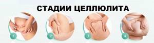 Anti-cellulite massage at home. How to do to lose weight in the abdomen, legs, buttocks and other parts of the body. Step-by-step instructions with photos 