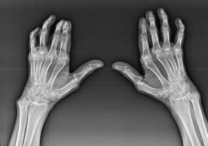 Артроз кисти руки на рентген снимке