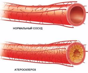 Atherosclerosis of the vessel