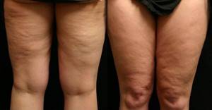 Cellulite stage 3