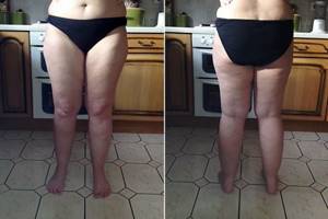 Cellulite stage 4