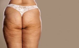 Cellulite on thighs and buttocks