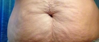 Cellulite on the stomach