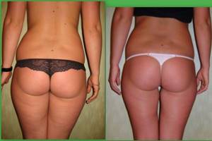 before and after anti-cellulite massage