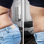 before and after abdominal mesotherapy