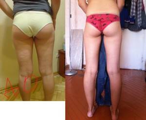 Charcot shower for weight loss - before and after photos