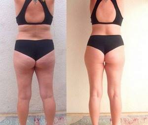 Charcot shower for weight loss - before and after photos