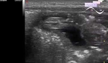 Worms on ultrasound