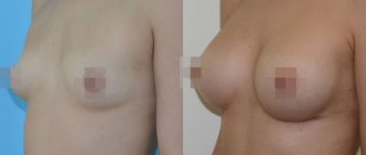 Breasts before and after plastic surgery - 1