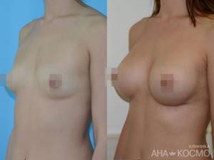 Breasts before and after plastic surgery - 1