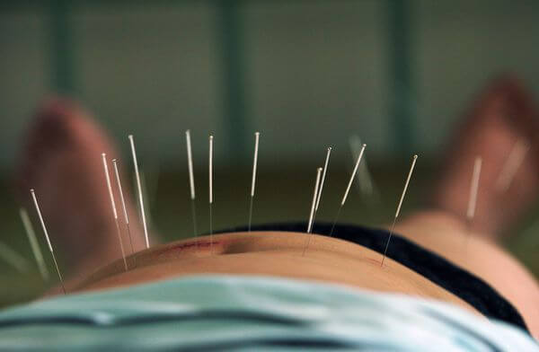 Acupuncture for weight loss