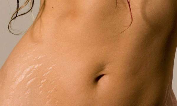 Needles for stretch marks on the skin