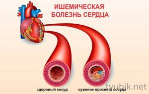 Cardiac ischemia