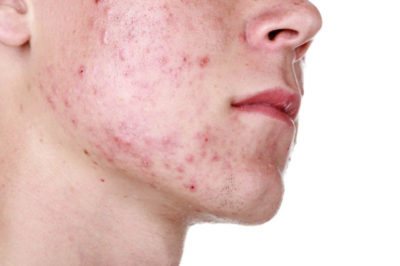 How to get rid of painful acne on your face