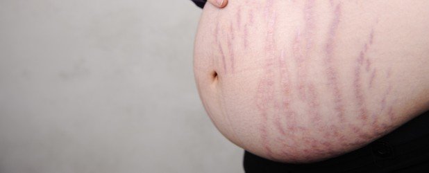 How to Avoid Stretch Marks