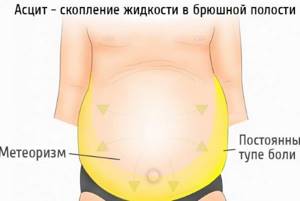 How to remove a big belly in women and men. Causes and solutions 
