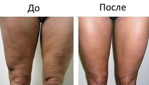 How to remove sagging skin on legs