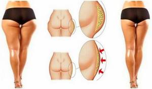 How to remove ears on the thighs: step-by-step instructions