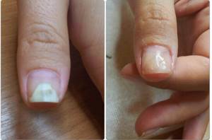 When do you need fast nail growth?