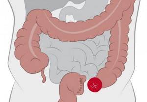 Colostomy: you need to eat right