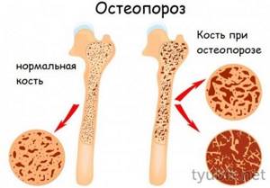 Bone in osteoporosis