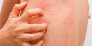 Skin allergic manifestations