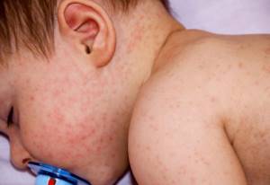 Hives in a child on the face and shoulders