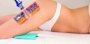 laser lipolysis features