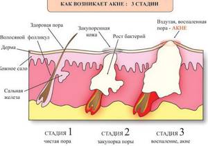 Mechanism of acne development