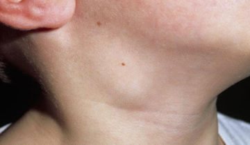 Can lymph nodes enlarge due to worms, is there a connection?