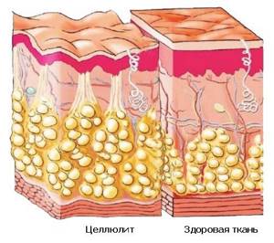 Cellulite formation