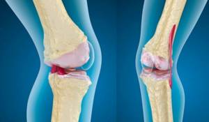 Osteoarthritis is a disease that occurs quite often