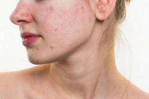what causes acne on the face and how to deal with it