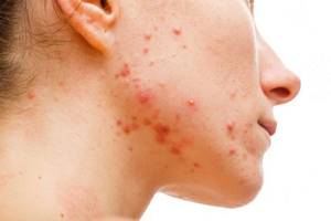 what causes pimples with pus on the face