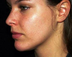 Why do you get acne on your face at 30?