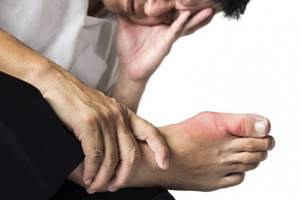 Swelling is a symptom of gout