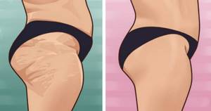 Where does cellulite come from?
