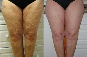 causes of sagging skin on thighs