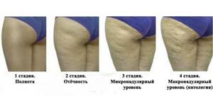 signs of cellulite stage