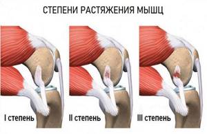 Knee muscle strain
