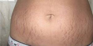 Stretch marks on the stomach