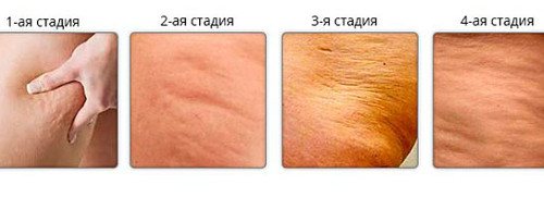 Stages of cellulite 1 - edematous stage; 2 - stage of formation of compactions; 3- liposclerosis; 4 - indurative stage 
