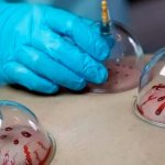 Hijama points with diagrams and explanations