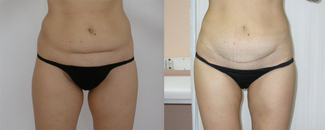 Belly after cesarean before and after weight loss
